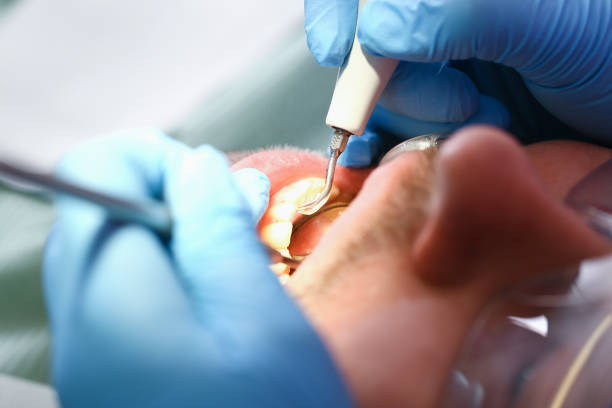 Best Broken or Chipped Tooth Repair in New Boston, OH